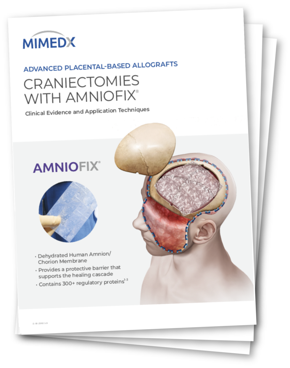 Craniectomies With AMNIOFIX MIMEDX Craniectomies With AMNIOFIX MIMEDX